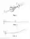 Fig. 02 - Delivery systems and methods of implantation for prosthetic heart valves