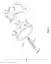 Fig. 02 - Acetabular prosthesis system