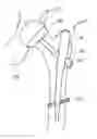 Fig. 01 - Durable resurfacing hip replacement device