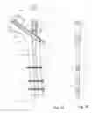 Fig. 08 - Durable resurfacing hip replacement device