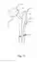 Fig. 09 - Durable resurfacing hip replacement device