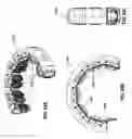 Fig. 71 - REMOTELY POWERED REMOTELY ADJUSTABLE GASTRIC BAND SYSTEM