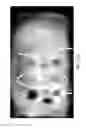 Fig. 35 - Compression device for enhancing normal/abnormal tissue contrast in MRI including devices and methods related thereto