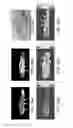 Fig. 44 - Compression device for enhancing normal/abnormal tissue contrast in MRI including devices and methods related thereto