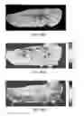 Fig. 45 - Compression device for enhancing normal/abnormal tissue contrast in MRI including devices and methods related thereto
