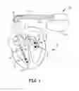 Fig. 02 - METHOD AND APPARATUS FOR DETECTING AND DISCRIMINATING TACHYCARDIA