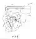 Fig. 02 - Method and apparatus for detecting and discriminating tachycardia