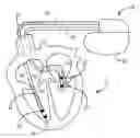 Fig. 01 - Method and apparatus for detecting and discriminating tachycardia