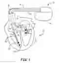 Fig. 02 - Method and apparatus for detecting and discriminating tachycardia
