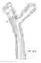 Fig. 09 - Pressure/vacuum actuated catheter forceps