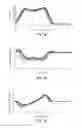Fig. 06 - Method and system for knee joint evaluation and diagnostic aid in normal and pathologic state