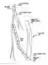 Fig. 01 - Percutaneous collateral bypass