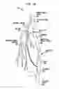 Fig. 06 - Percutaneous collateral bypass