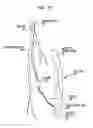 Fig. 08 - Percutaneous collateral bypass