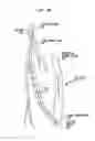 Fig. 09 - Percutaneous collateral bypass