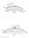 Fig. 05 - Device for treating hardened lesions