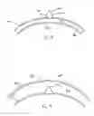Fig. 06 - Device for treating hardened lesions