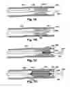 Fig. 04 - Method and apparatus for increasing blood flow through an obstructed blood vessel