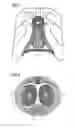 Fig. 02 - Infusion of drugs