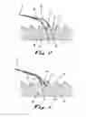 Fig. 04 - Drug delivery device
