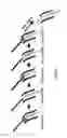 Fig. 02 - Catheter system providing step reduction for postconditioning