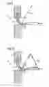 Fig. 08 - Infusion of drugs