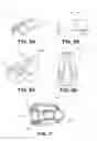 Fig. 05 - Suturing and repairing tissue using in vivo suture loading