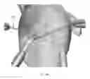 Fig. 21 - Suturing and repairing tissue using in vivo suture loading