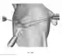 Fig. 22 - Suturing and repairing tissue using in vivo suture loading