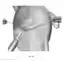 Fig. 23 - Suturing and repairing tissue using in vivo suture loading