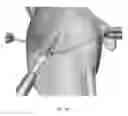 Fig. 25 - Suturing and repairing tissue using in vivo suture loading