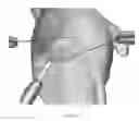 Fig. 26 - Suturing and repairing tissue using in vivo suture loading