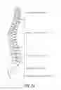 Fig. 02 - SPINAL IMPLANT