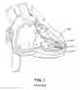 Fig. 02 - Two-Stage Delivery Systems and Methods for Fixing a Leadless Implant to Tissue