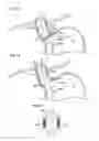 Fig. 12 - Bulimia treatment
