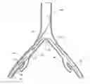 Fig. 01 - INTRODUCER FOR AN ILIAC SIDE BRANCH DEVICE