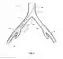 Fig. 02 - INTRODUCER FOR AN ILIAC SIDE BRANCH DEVICE