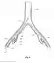 Fig. 06 - INTRODUCER FOR AN ILIAC SIDE BRANCH DEVICE