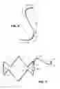 Fig. 04 - Mobile external coupling for branch vessel connection