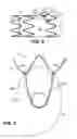 Fig. 05 - Mobile external coupling for branch vessel connection