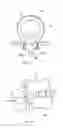 Fig. 16 - Mechanical Apparatus and Method for Artificial Disc Fusion and Nucleus Replacement