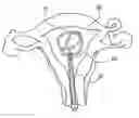 Fig. 01 - Intra uterine device