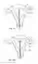 Fig. 02 - Intra uterine device