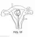 Fig. 05 - Intra uterine device