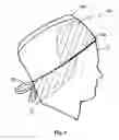 Fig. 07 - SHIELDED SURGICAL GARMENT