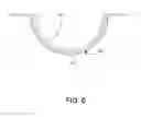 Fig. 06 - Surface enhanced ophthalmic lens