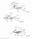 Fig. 74 - Lumen-traveling biological interface device and method of use