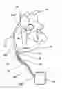 Fig. 01 - Percutaneous gas-line
