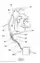 Fig. 03 - Percutaneous gas-line