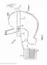 Fig. 02 - Self-regulating gastric band with pressure data processing